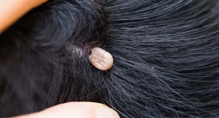 Ho appena scoperto questo nei capelli di mio figlio. Cos’è? Non so se dovremmo andare dal medico.