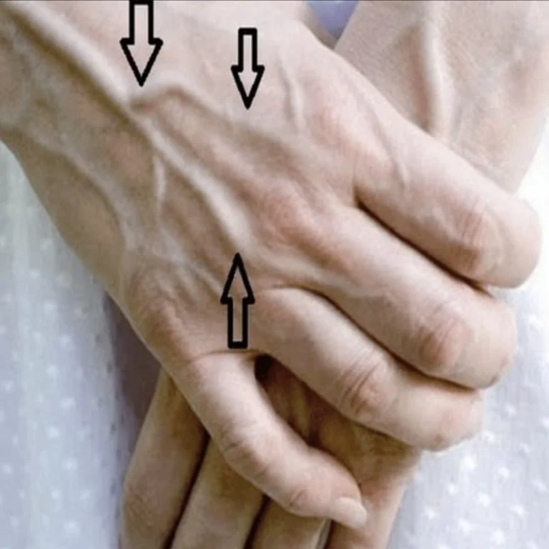 Vene visibili: cosa significano?