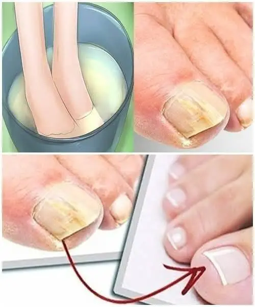 Sbarazzati dei funghi alle unghie con questi rimedi casalinghi