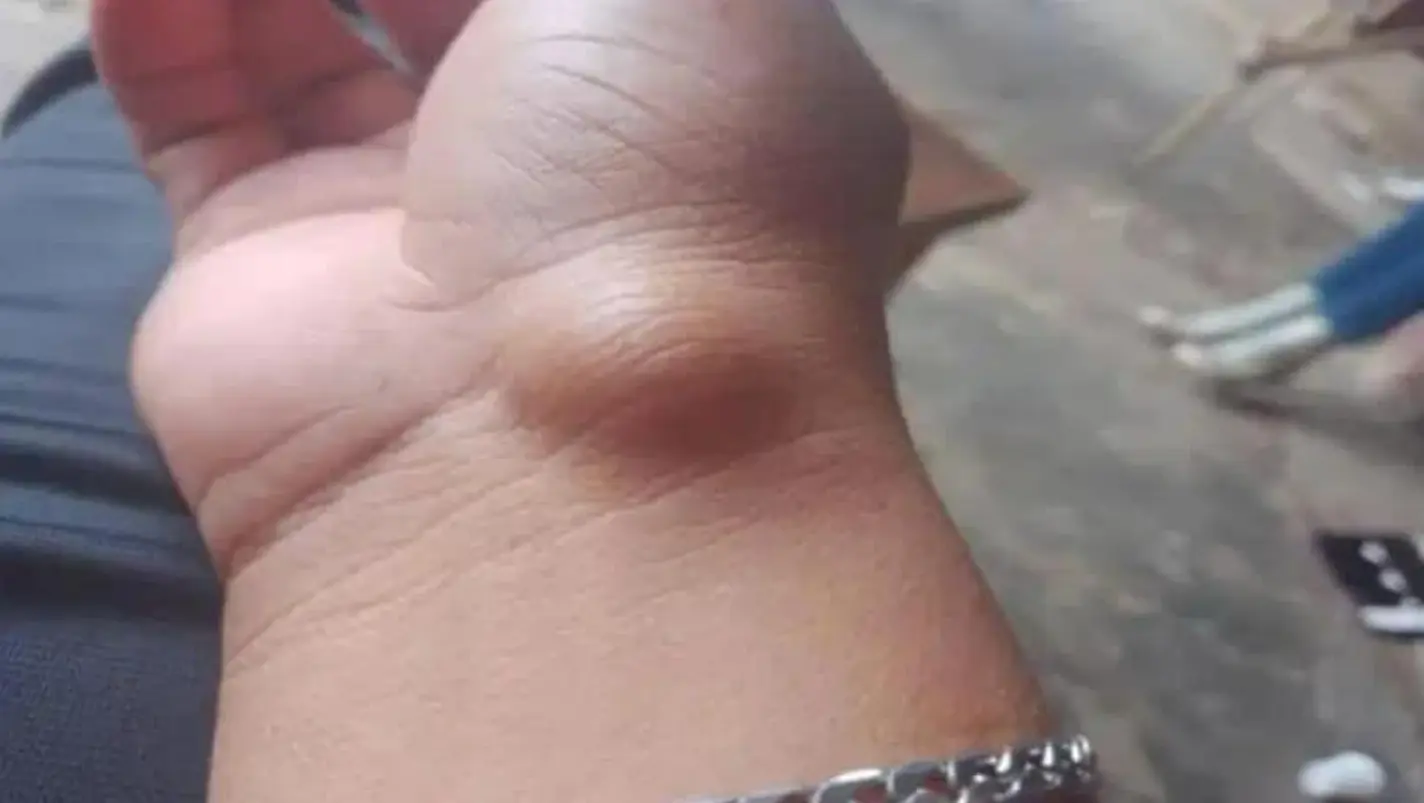 Ganglio del polso: cause, sintomi e trattamenti.