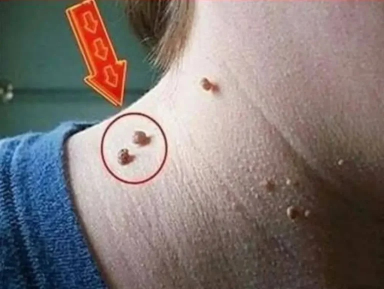 Sbarazzati di verruche, punti neri e macchie senili in modo naturale