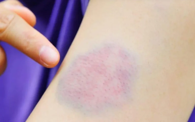 Perché compaiono i lividi sulla pelle?