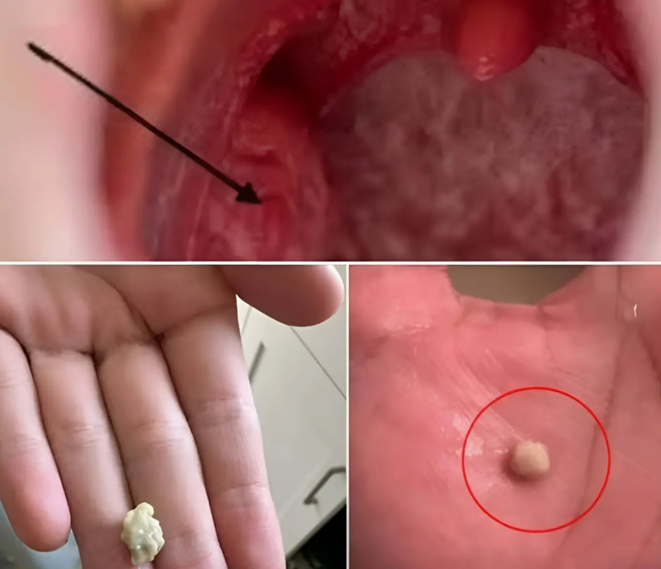 Ecco cosa devi sapere sui calcoli tonsillari